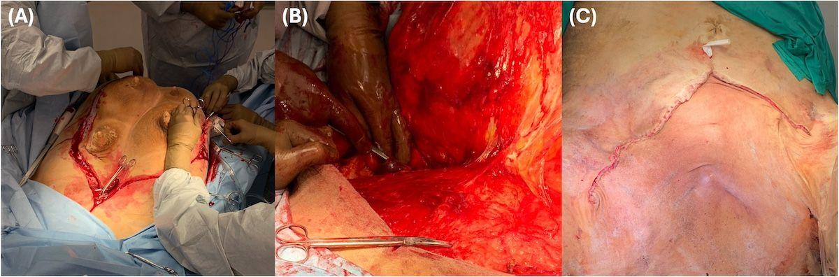 Figures 2a, 2b, 2c. (a) An elliptical skin incision to facilitate a total mastectomy in a cow. (b) The left pudendal vein ligated and isolated for transection. (c) Surgical closure in a V pattern with a ventrally positioned Penrose drain.