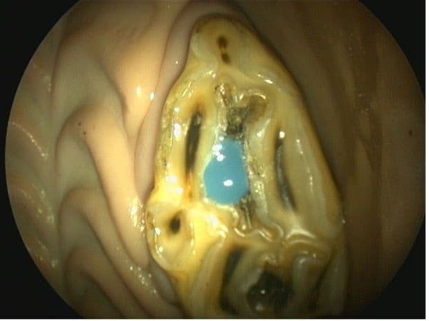 Figure 3C. Flushing of Cavity Preparation and Application of Bonding Product. Disinfectant solutions are flushed into the cavity preparation and a layer of a single step-etch bonding product is applied to the walls of the cavity.