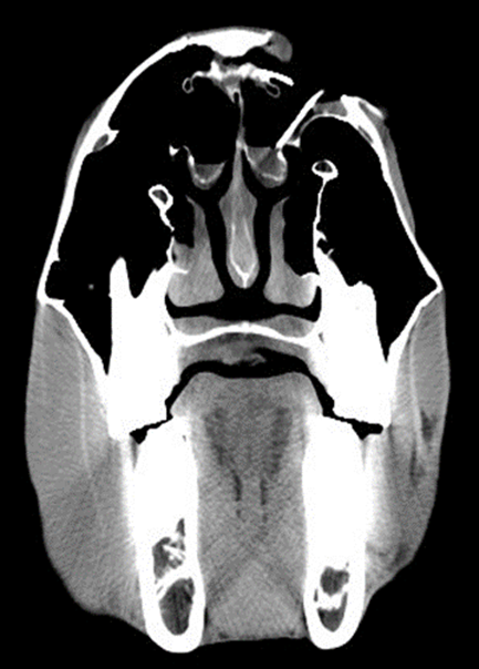 Figure 1b. Corresponding CT image identifying an open, complete, and displaced fracture of the skull involving the left paranasal sinuses.