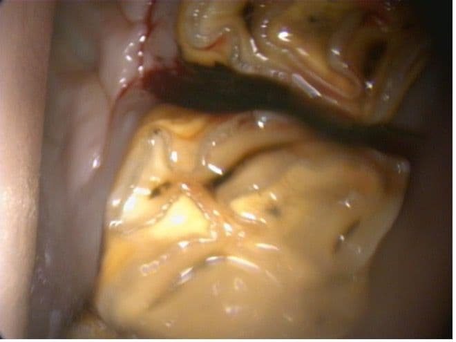 Figure 1B. Diastema After Flushing With Periodontal unit.