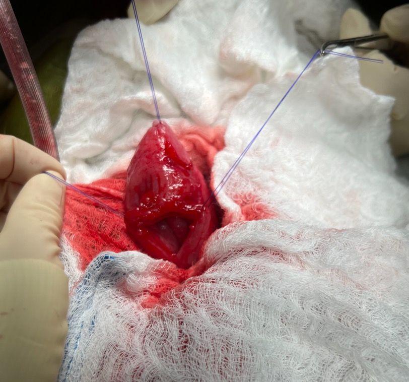 Figure 2: Stay suture placement at the bladder apex to optimize visualization and manipulation