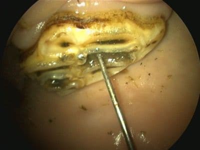 Figure 3B. Debridement of Caris Using High-Speed Dental Drill/Burr.