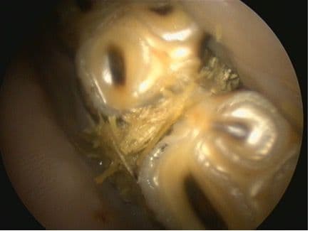 Figure 1A. Diastema Between Two Cheek Teeth With Food Accumulation.