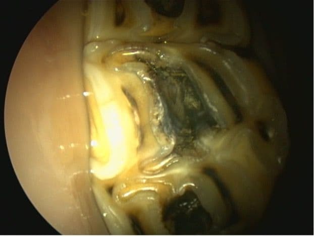 Figure 3A. Maxillary CT Infundibular Cemental Caries.