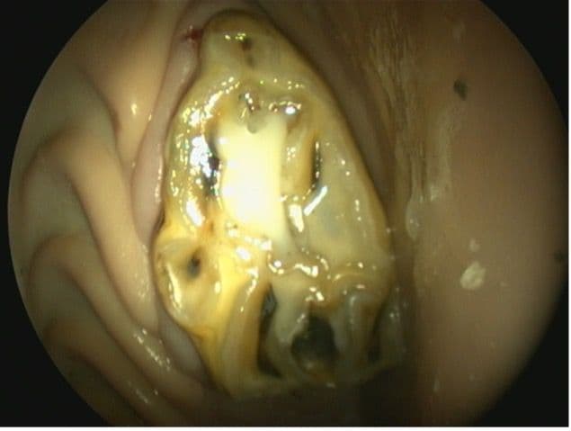 Figure 3D. Cavity Filled With Dual-Cured Flowable Resin Composite.