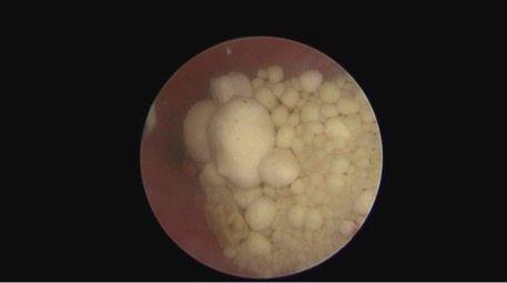 Figure 1: Uroliths at the trigone of the bladder as observed using endoscopy.