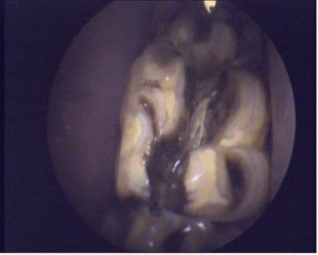 Figure 2. Midline Sagittal Fracture of Maxillary Cheek Tooth.